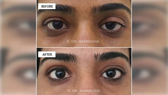 Upper Lid Ptosis Surgery