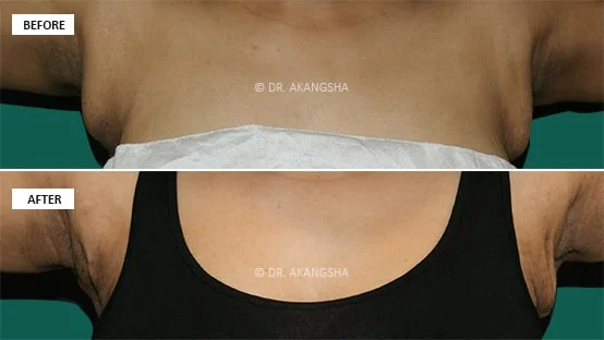 Axillary Breas-t in Female before and after photos