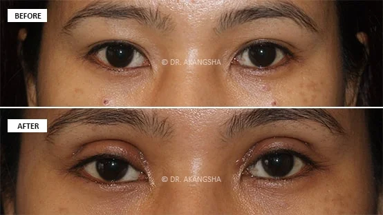 blepharoplasty before and after photos
