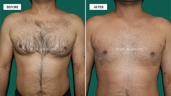 Male Chest/ Gynecomastia before and after photos