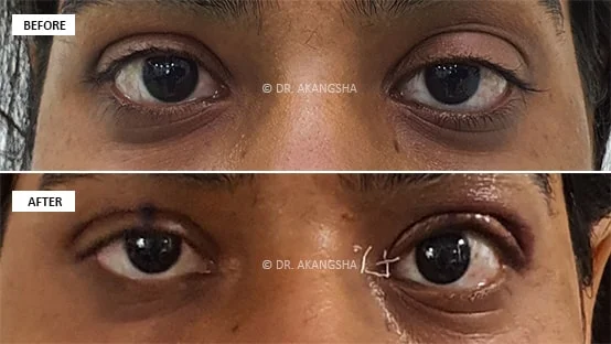 Upper Lid Ptosis Surgery before and after photos
